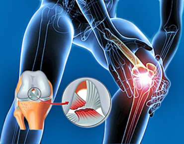 Lesión De Ligamento Cruzado Anterior Clínica Fisioterapia Ciudadela